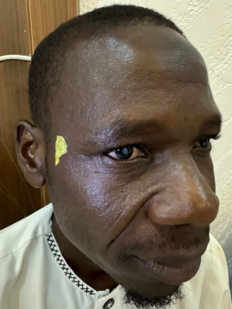 Afrika’da Katarakt Ameliyatı 5